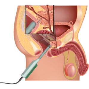Biópsia da próstata