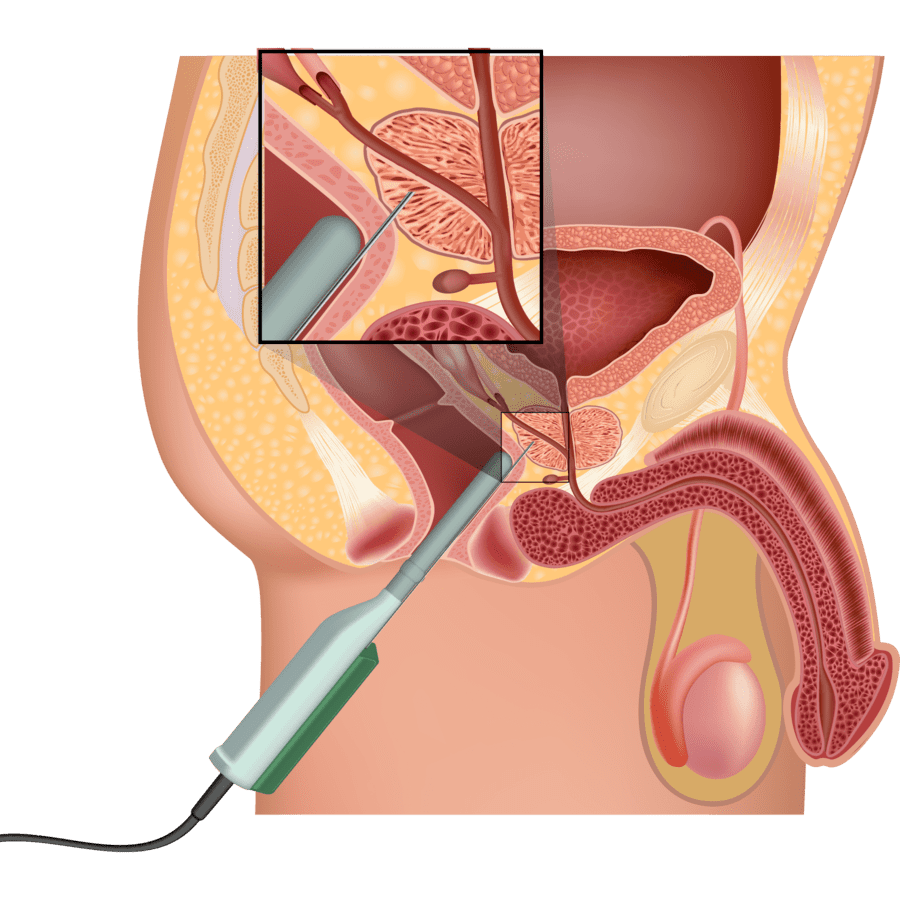 Biópsia da próstata