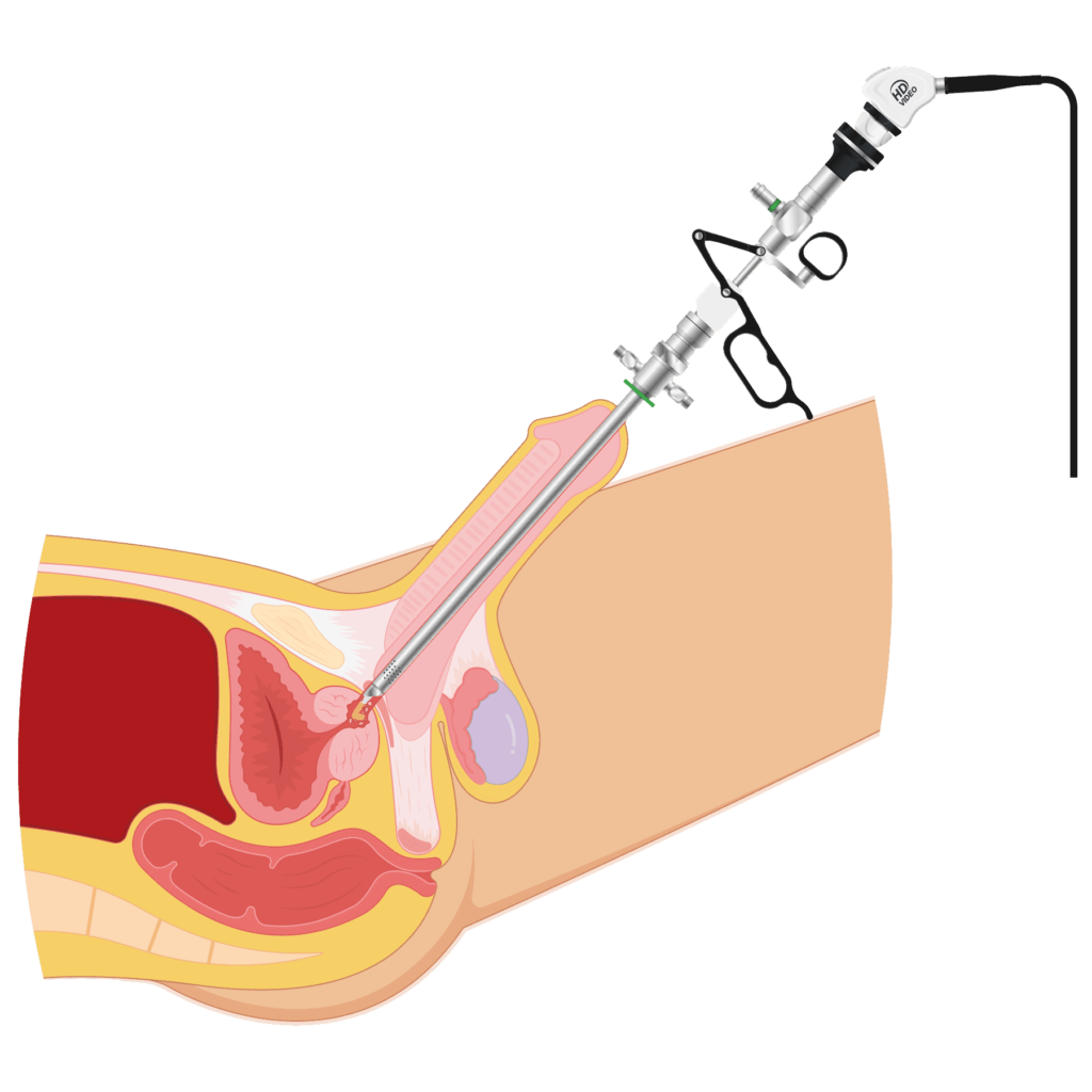 Cirurgia a laser da próstata