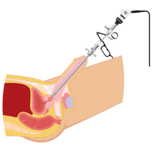 Cirurgia a laser da próstata