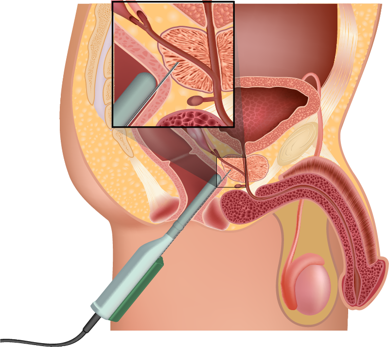 Biópsia da próstata guiada por ultrassom trans-retal